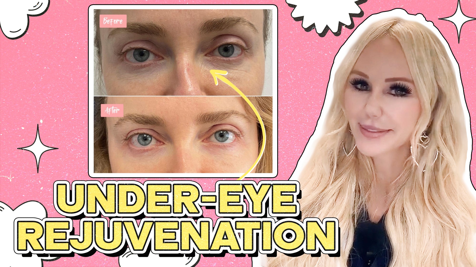 Rejuvenating the Under-Eye Area: What You Need to Know