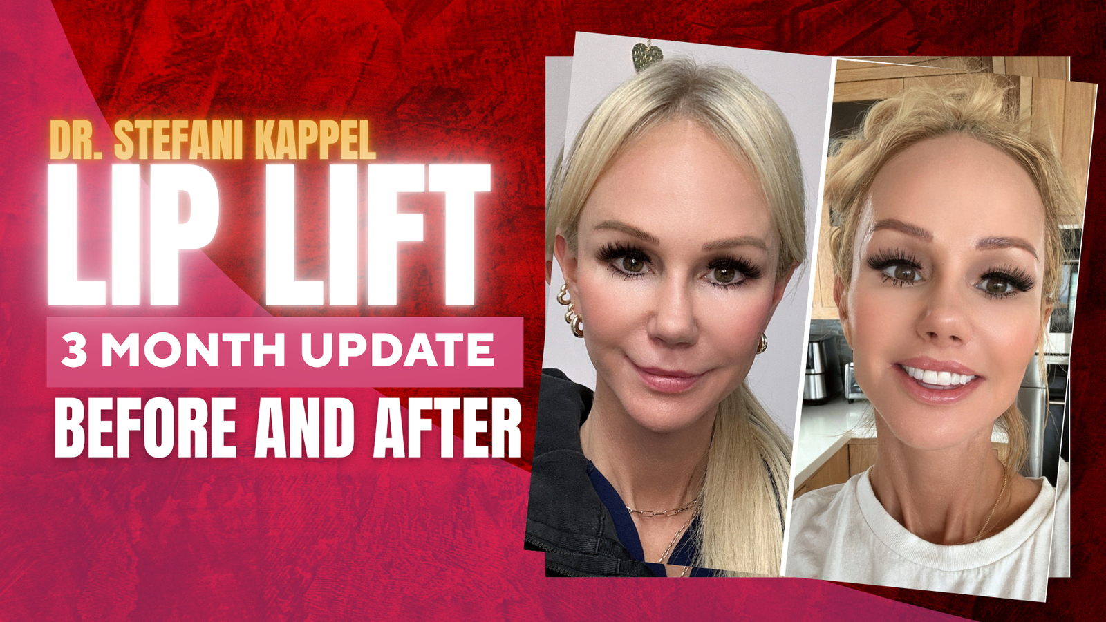 Is a Lip Lift Worth It? My Honest Experience 3 months after surgery